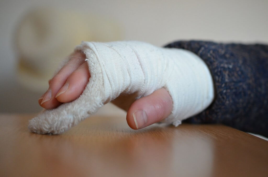 Una frattura alla mano, può coinvolgere qualsiasi osso presente nella mano. Si verifica quando un osso o più ossa si rompono o si incrinano, spesso in seguito a caduta o ad attività sportiva
