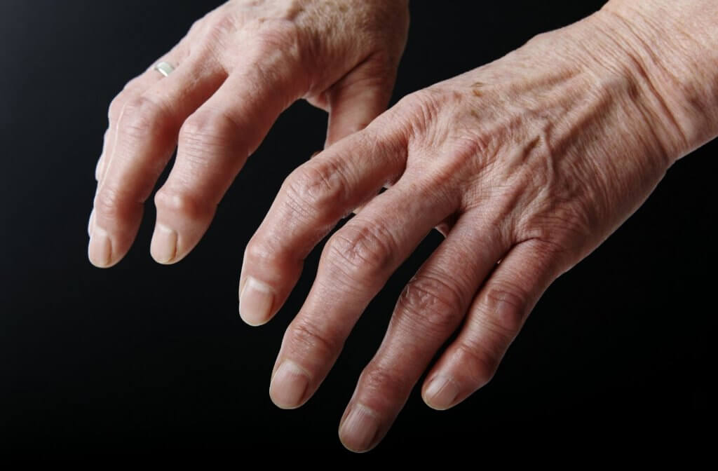 L’artrosi è una patologia cronica a carico delle articolazioni dove si assiste alla degenerazione progressiva della cartilagine articolare. Un approfondimento.