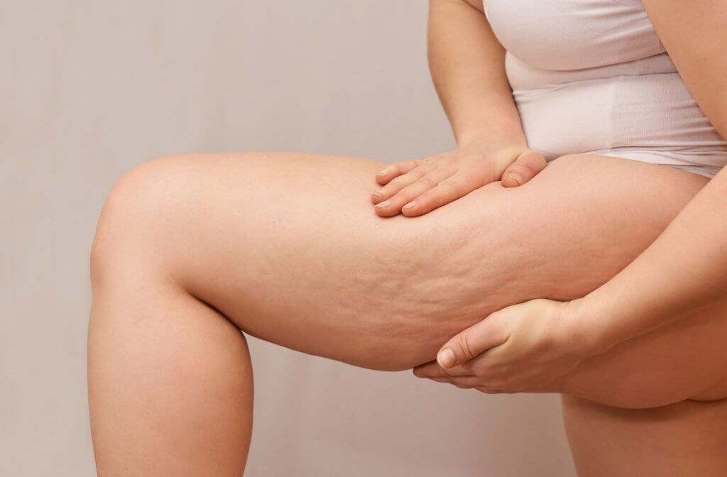 La ritenzione idrica è per molti un fastidioso problema che fa sentire le gambe pesanti. Per combatterla è importante seguire alcune semplici regole, vediamo quali.
